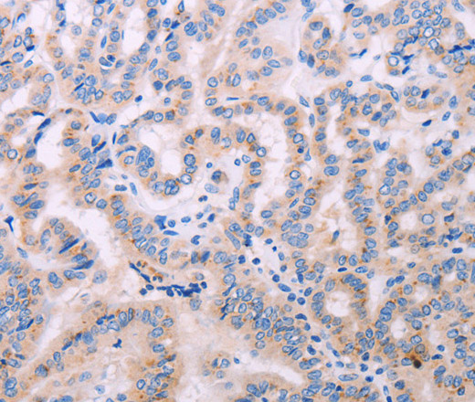 Immunohistochemistry of paraffin-embedded Human thyroid cancer tissue using ADCY5 Polyclonal Antibody at dilution 1:40