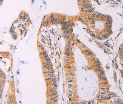 Immunohistochemistry of paraffin-embedded Human colon cancer tissue using ADCY1 Polyclonal Antibody at dilution 1:60