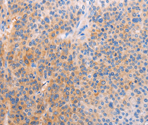 Immunohistochemistry of paraffin-embedded Human liver cancer tissue using ADHFE1 Polyclonal Antibody at dilution 1:60