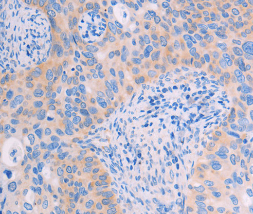 Immunohistochemistry of paraffin-embedded Human cervical cancer tissue using ADHFE1 Polyclonal Antibody at dilution 1:60