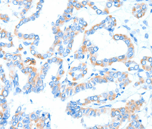 Immunohistochemistry of paraffin-embedded Human thyroid cancer tissue using GPT Polyclonal Antibody at dilution 1:55