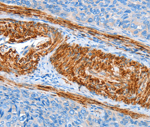 Immunohistochemistry of paraffin-embedded Human cervical cancer tissue using AARS Polyclonal Antibody at dilution 1:60