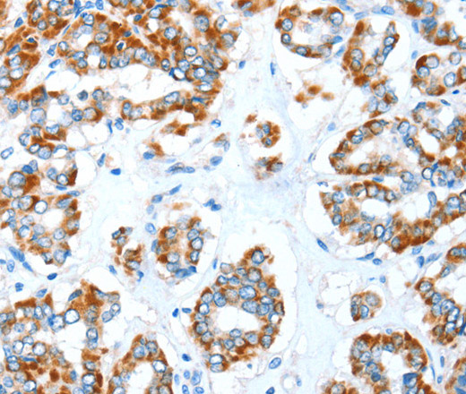 Immunohistochemistry of paraffin-embedded Human thyroid cancer tissue using ALDH5A1 Polyclonal Antibody at dilution 1:35