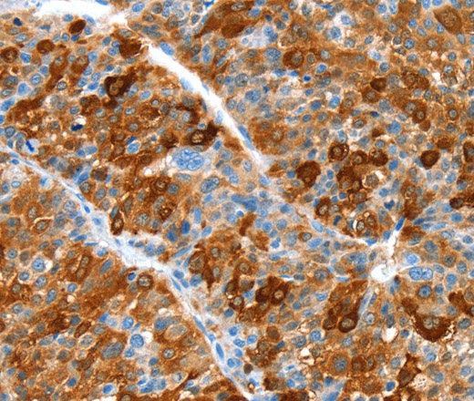 Immunohistochemistry of paraffin-embedded Human liver cancer using ALDOB Polyclonal Antibody at dilution of 1:55