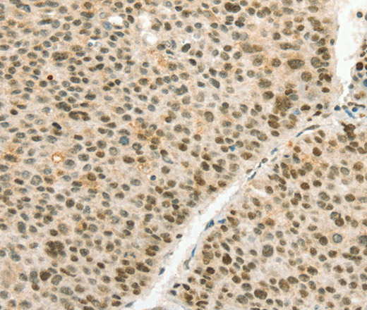 Immunohistochemistry of paraffin-embedded Human liver cancer using ANGPT4 Polyclonal Antibody at dilution of 1:70