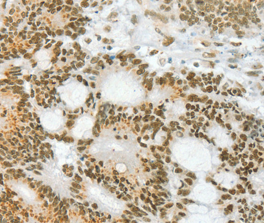 Immunohistochemistry of paraffin-embedded Human colon cancer using ANGPT4 Polyclonal Antibody at dilution of 1:70