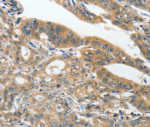 Immunohistochemistry of paraffin-embedded Human gasrtic cancer tissue using ANKZF1 Polyclonal Antibody at dilution 1:40