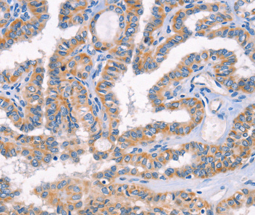 Immunohistochemistry of paraffin-embedded Human thyroid cancer tissue using AP1B1 Polyclonal Antibody at dilution 1:70