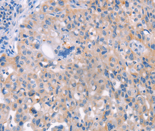 Immunohistochemistry of paraffin-embedded Human lung cancer tissue using AP1B1 Polyclonal Antibody at dilution 1:70