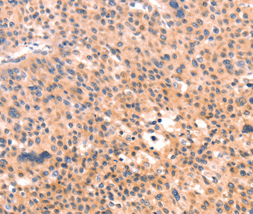 Immunohistochemistry of paraffin-embedded Human liver cancer tissue using APBA2 Polyclonal Antibody at dilution 1:80