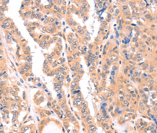 Immunohistochemistry of paraffin-embedded Human thyroid cancer tissue using APBA2 Polyclonal Antibody at dilution 1:80