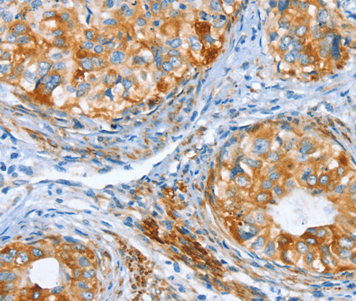 Immunohistochemistry of paraffin-embedded Human cervical cancer tissue using AIP Polyclonal Antibody at dilution 1:80