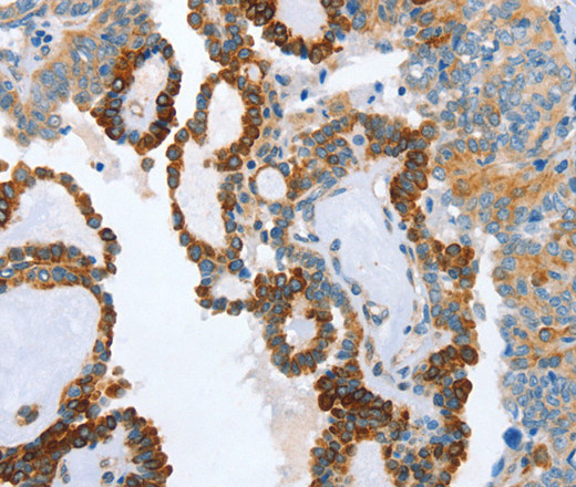 Immunohistochemistry of paraffin-embedded Human thyroid cancer tissue using AIP Polyclonal Antibody at dilution 1:80