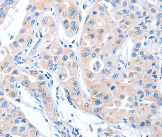 Immunohistochemistry of paraffin-embedded Human lung cancer tissue using ARHGEF6 Polyclonal Antibody at dilution 1:70