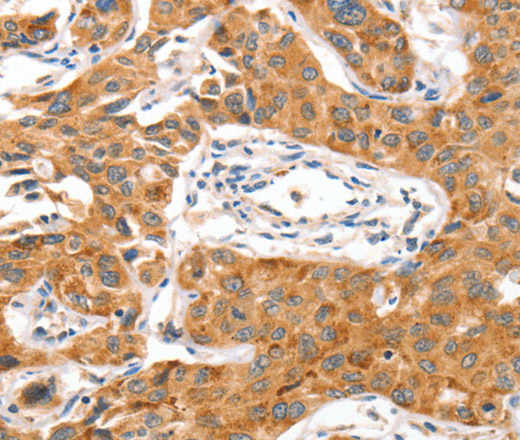 Immunohistochemistry of paraffin-embedded Human lung cancer tissue using NUAK1 Polyclonal Antibody at dilution 1:70