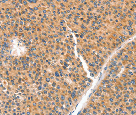 Immunohistochemistry of paraffin-embedded Human liver cancer tissue using NUAK1 Polyclonal Antibody at dilution 1:70