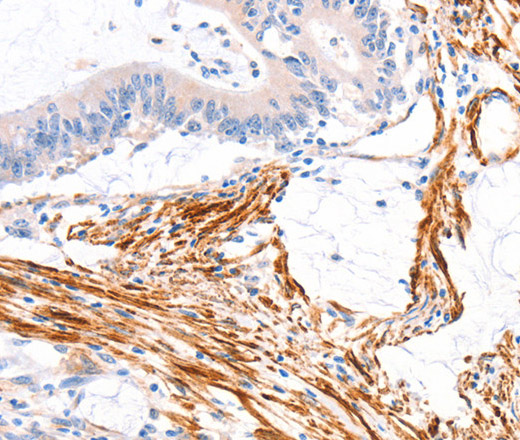 Immunohistochemistry of paraffin-embedded Human colon cancer tissue using ARAP1 Polyclonal Antibody at dilution 1:80