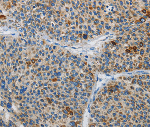 Immunohistochemistry of paraffin-embedded Human liver cancer using ATG4A Polyclonal Antibody at dilution of 1:30