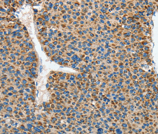 Immunohistochemistry of paraffin-embedded Human liver cancer using DSCR1 Polyclonal Antibody at dilution of 1:45