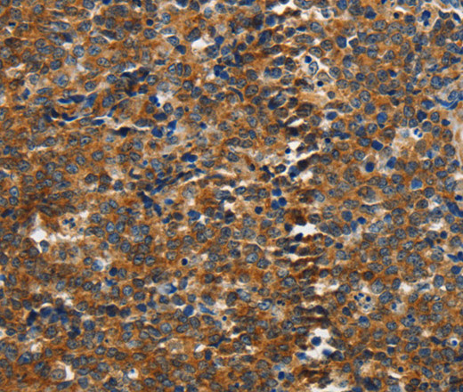 Immunohistochemistry of paraffin-embedded Human lymphoma tissue using PIK3R4 Polyclonal Antibody at dilution 1:85