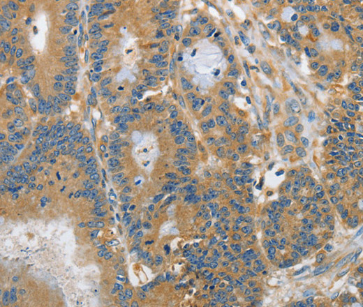 Immunohistochemistry of paraffin-embedded Human colon cancer tissue using DGK zeta Polyclonal Antibody at dilution 1:60