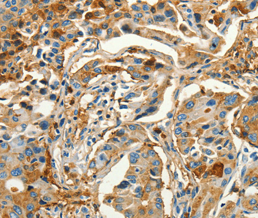 Immunohistochemistry of paraffin-embedded Human lung cancer tissue using CALCA Polyclonal Antibody at dilution 1:60