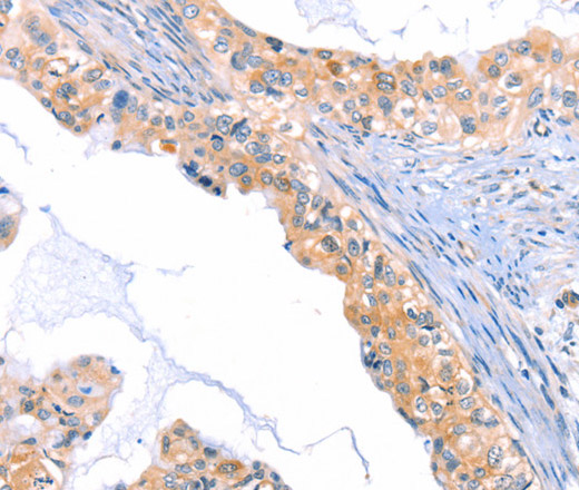 Immunohistochemistry of paraffin-embedded Human cervical cancer tissue using THBS1 Polyclonal Antibody at dilution 1:60