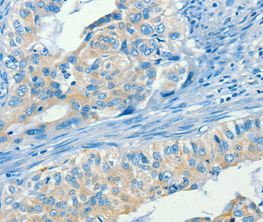 Immunohistochemistry of paraffin-embedded Human cervical cancer using SERPINA9 Polyclonal Antibody at dilution of 1:60