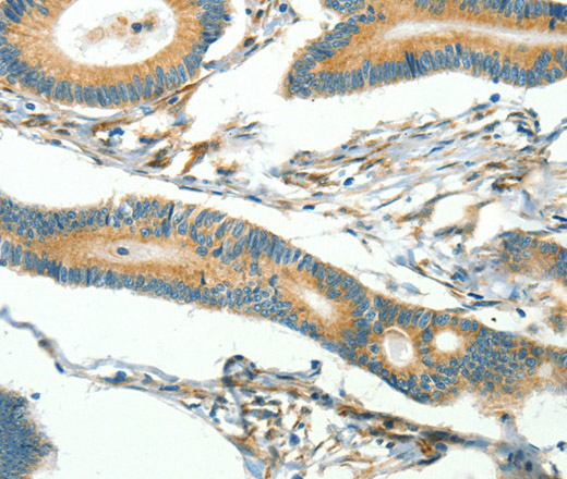 Immunohistochemistry of paraffin-embedded Human thyroid cancer using CAV3 Polyclonal Antibody at dilution of 1:40