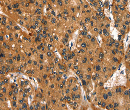 Immunohistochemistry of paraffin-embedded Human liver cancer tissue using SLC6A4 Polyclonal Antibody at dilution of 1:50