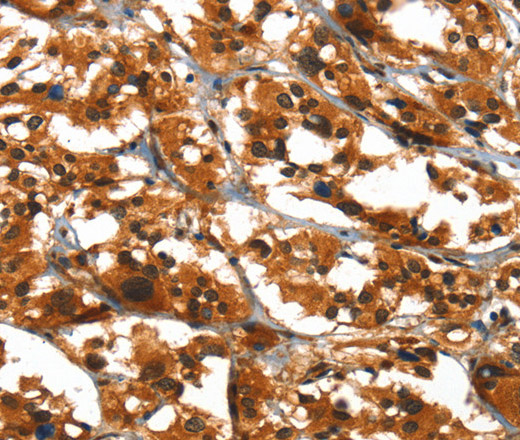 Immunohistochemistry of paraffin-embedded Human thyroid cancer using SLC6A4 Polyclonal Antibody at dilution of 1:50