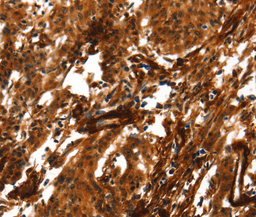 Immunohistochemistry of paraffin-embedded Human gastric cancer using ACTA2 Polyclonal Antibody at dilution of 1:40