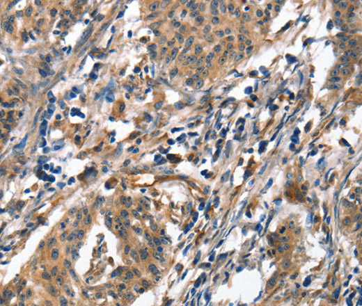 Immunohistochemistry of paraffin-embedded Human gasrtic cancer tissue using ALOX15 Polyclonal Antibody at dilution 1:50