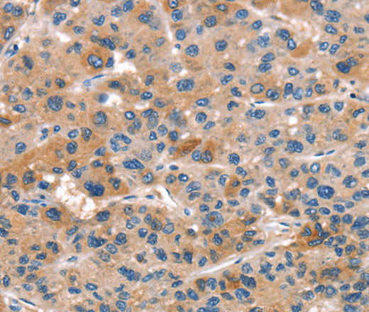 Immunohistochemistry of paraffin-embedded Human liver cancer tissue using ALOX15 Polyclonal Antibody at dilution 1:50