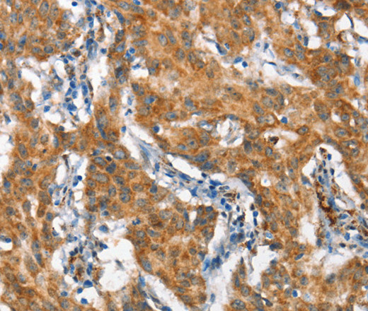 Immunohistochemistry of paraffin-embedded Human gastic cancer using STAT2 Polyclonal Antibody at dilution of 1:60