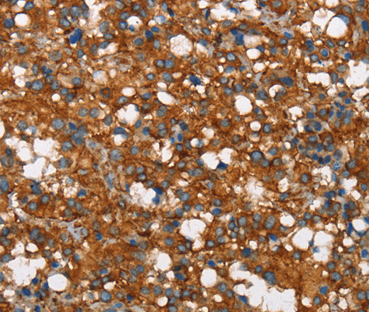 Immunohistochemistry of paraffin-embedded Human thyroid cancer tissue using COX5A Polyclonal Antibody at dilution 1:40