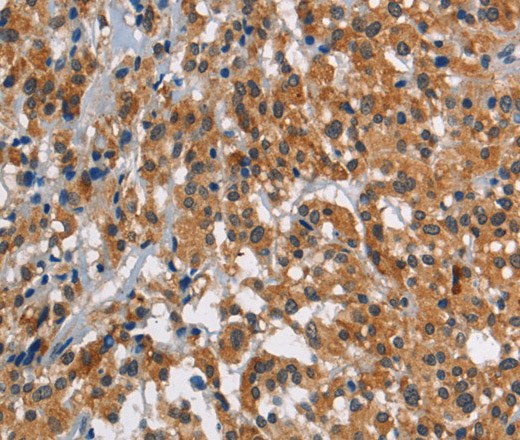 Immunohistochemistry of paraffin-embedded Human thyroid cancer using SMAD9 Polyclonal Antibody at dilution of 1:30