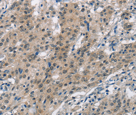 Immunohistochemistry of paraffin-embedded Human gastric cancer using SMAD9 Polyclonal Antibody at dilution of 1:30