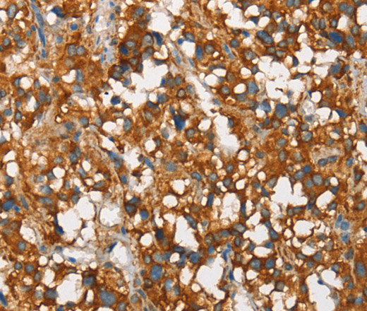 Immunohistochemistry of paraffin-embedded Human thyroid cancer tissue using SNCA Polyclonal Antibody at dilution 1:60