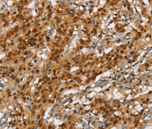 Immunohistochemistry of paraffin-embedded Human gasrtic cancer tissue using NLRP7 Polyclonal Antibody at dilution 1:60