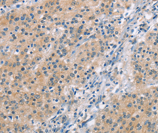 Immunohistochemistry of paraffin-embedded Human gasrtic cancer tissue using MCL1 Polyclonal Antibody at dilution 1:60