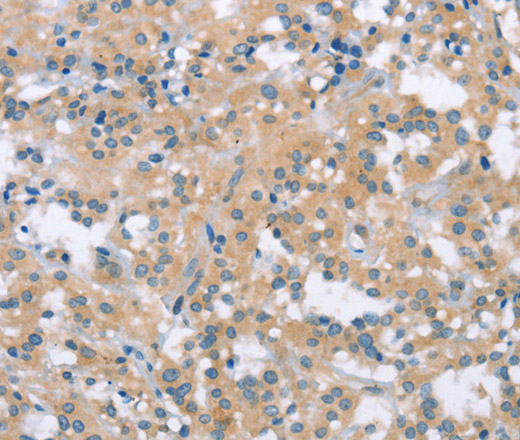 Immunohistochemistry of paraffin-embedded Human thyroid cancer tissue using MCL1 Polyclonal Antibody at dilution 1:60