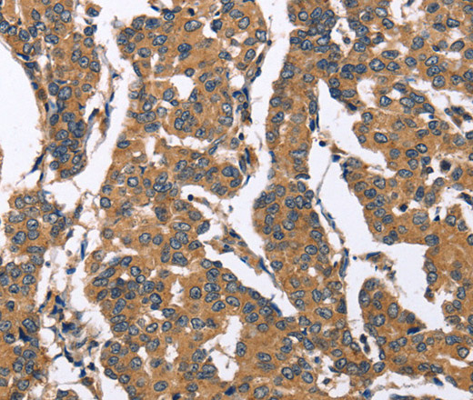 Immunohistochemistry of paraffin-embedded Human breast cancer tissue using BNIP2 Polyclonal Antibody at dilution 1:50