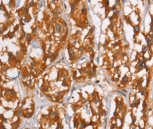 Immunohistochemistry of paraffin-embedded Human thyroid cancer using PLIN2 Polyclonal Antibody at dilution of 1:40