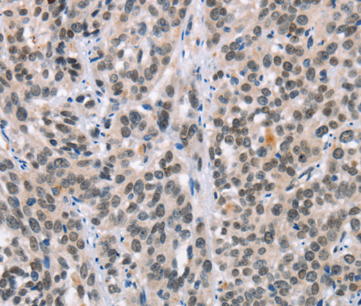 Immunohistochemistry of paraffin-embedded Human esophagus cancer tissue using ADNP Polyclonal Antibody at dilution 1:50