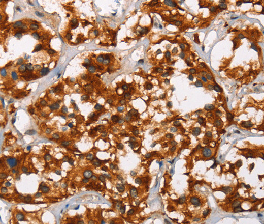 Immunohistochemistry of paraffin-embedded Human thyroid cancer tissue using ADNP Polyclonal Antibody at dilution 1:50