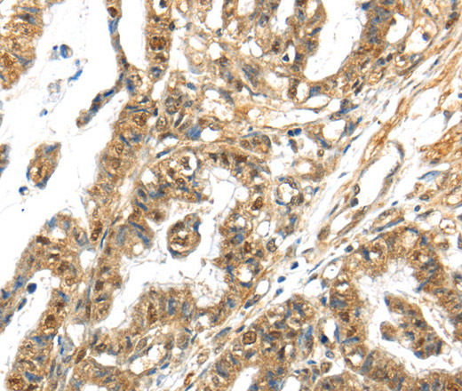 Immunohistochemistry of paraffin-embedded Human thyroid cancer tissue using APOL6 Polyclonal Antibody at dilution 1:60