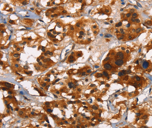 Immunohistochemistry of paraffin-embedded Human thyroid cancer tissue using ATRN Polyclonal Antibody at dilution 1:50