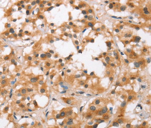 Immunohistochemistry of paraffin-embedded Human thyroid cancer using BCAS4 Polyclonal Antibody at dilution of 1:50