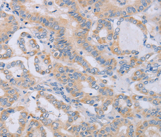 Immunohistochemistry of paraffin-embedded Human thyroid cancer using BGLAP Polyclonal Antibody at dilution of 1:40